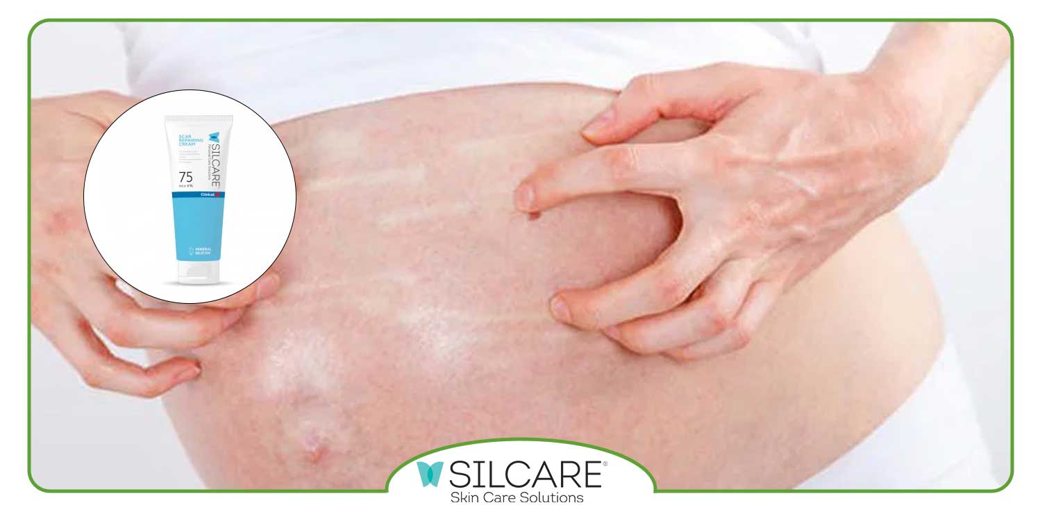 مزایای استفاده از پماد آنتی اسکار سیلکر