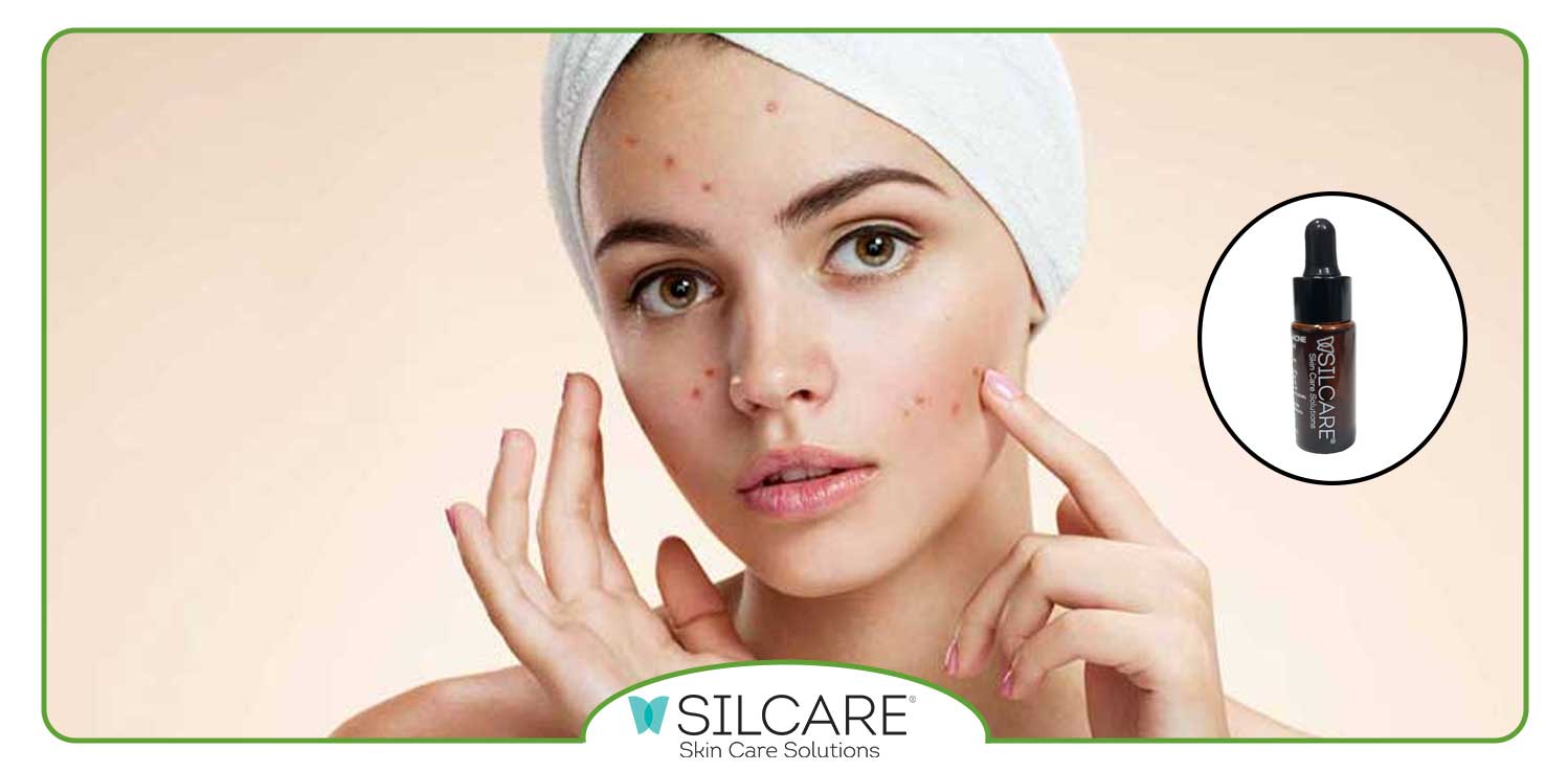 مزایای استفاده از سرم آنتی آکنه سیلکر