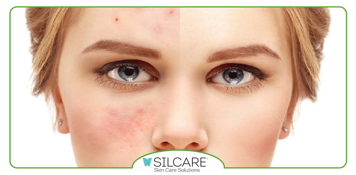 مزایای استفاده از کرم ترمیم کننده جای جوش چیست؟