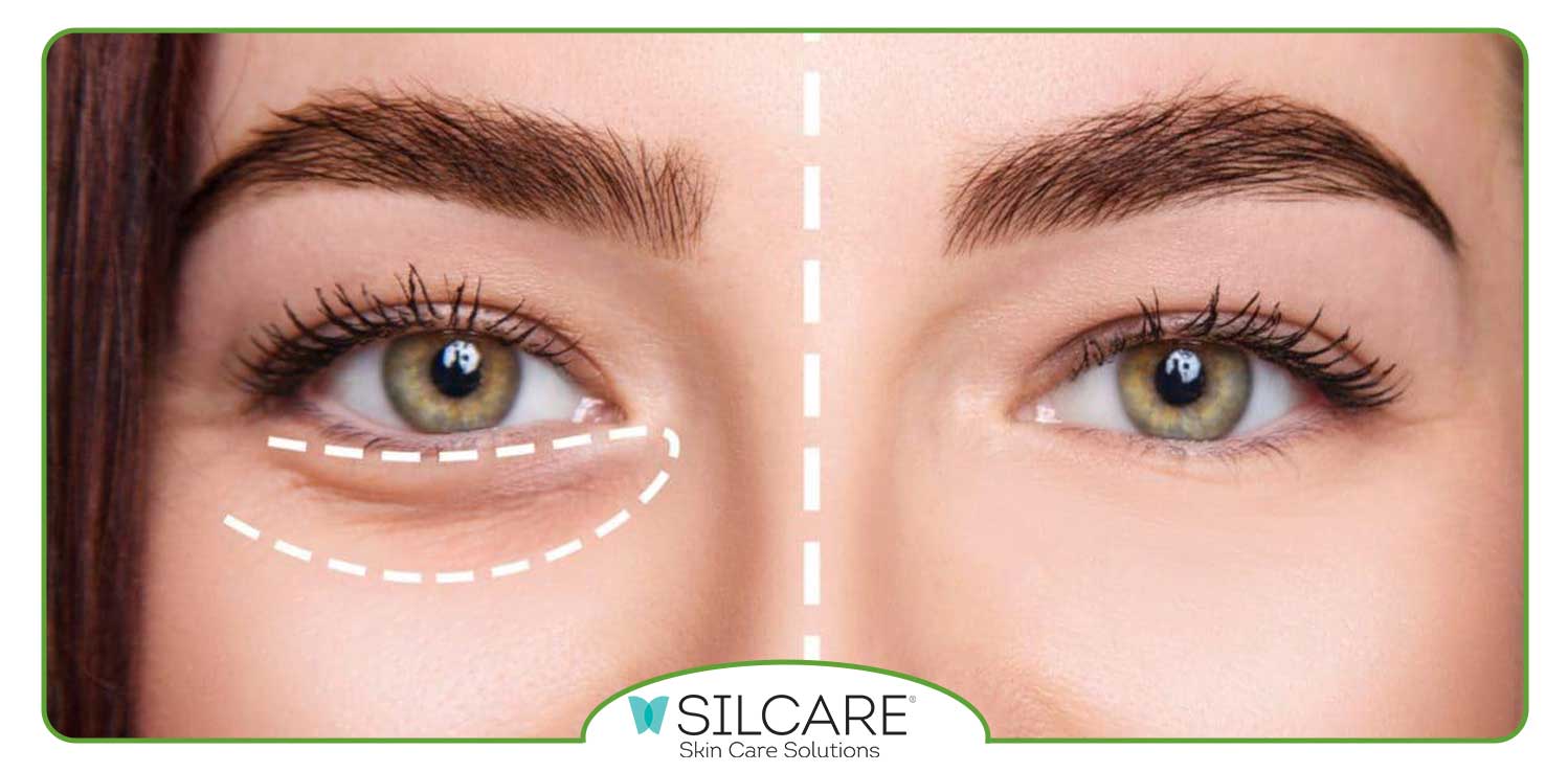 دلایل ایجاد پف زیر چشم چیست؟