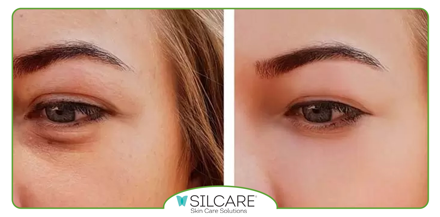 کمبود کدام ویتامین باعث پف زیر چشم می شود؟