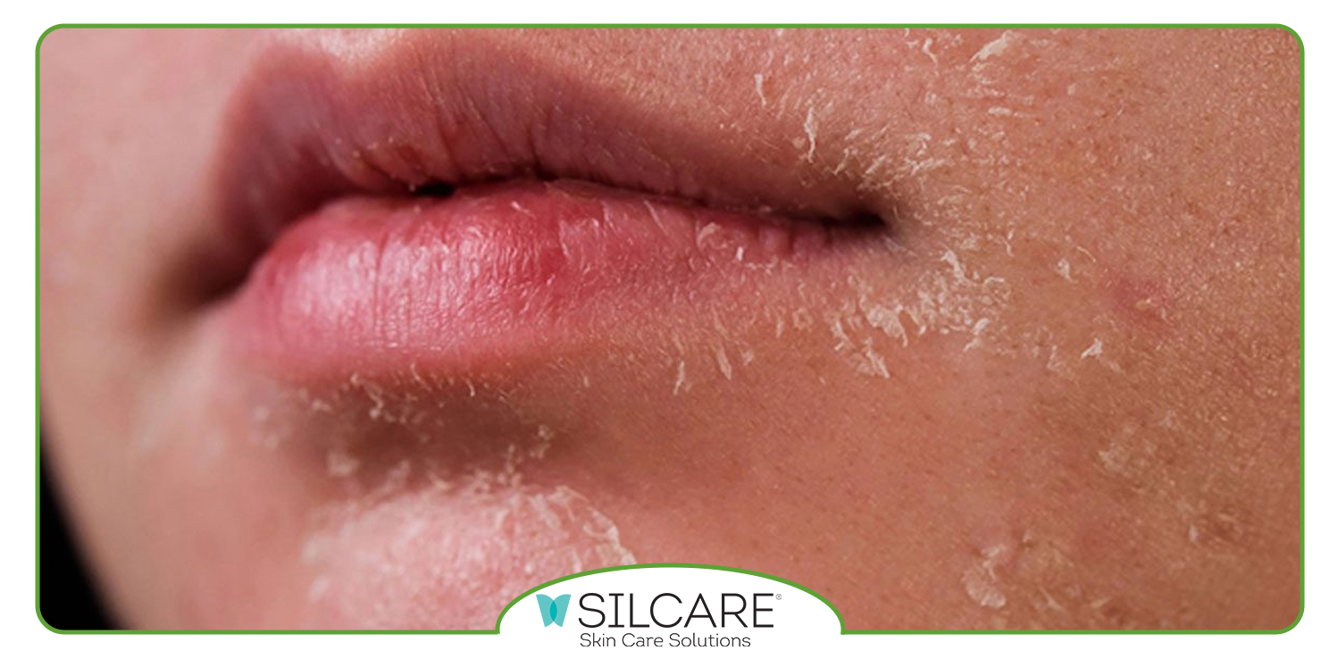 ترکیبات ژل ترمیم کننده پوست آسیب دیده سیلکر