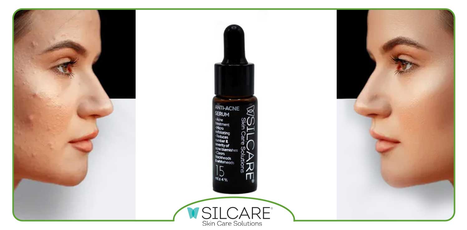 بهترین سرم ضد جوش برای پوست چرب