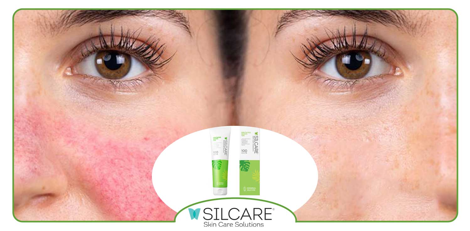 پماد برای قرمزی صورت