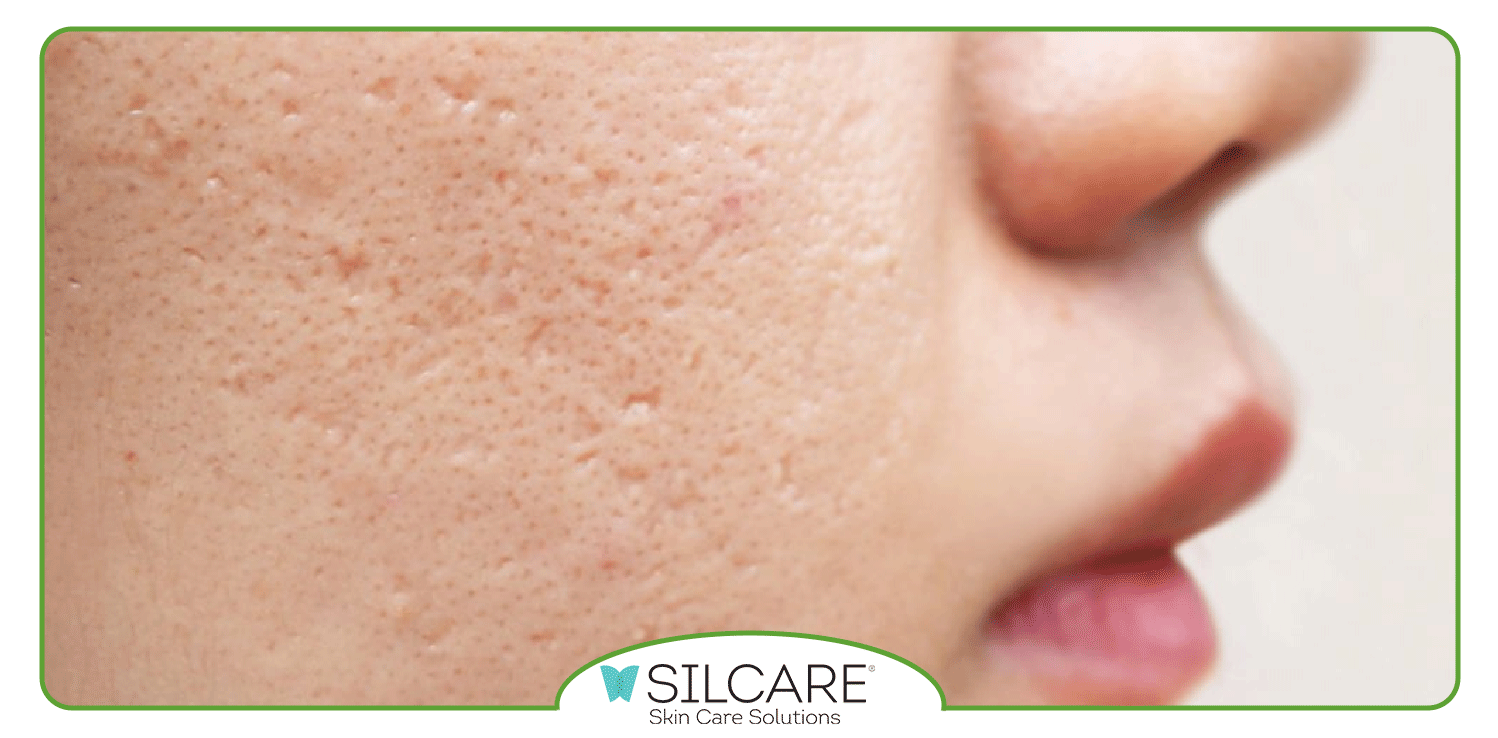 مزایای استفاده از کرم ترمیم کننده جای جوش سیلکر