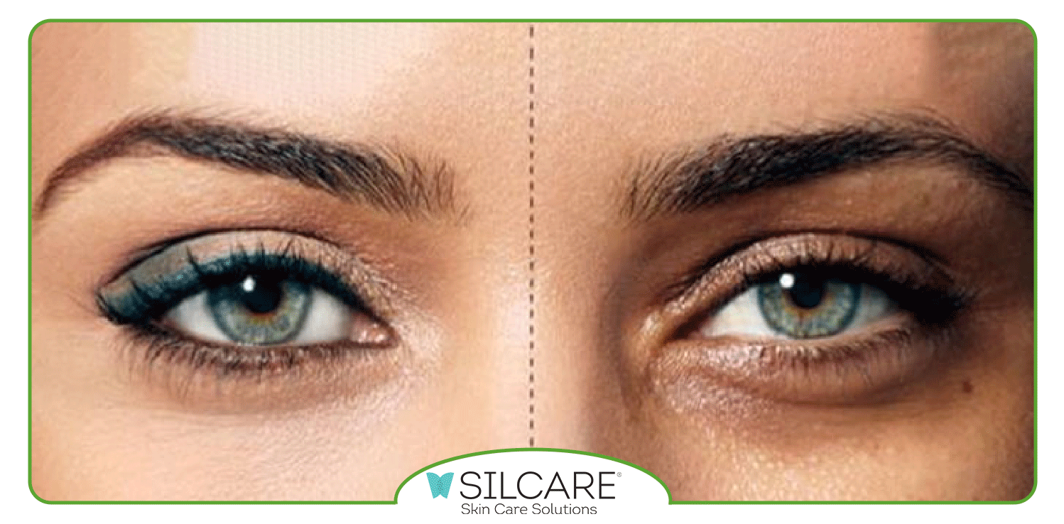 نحوه استفاده از سرم ویتامین C برای دور چشم