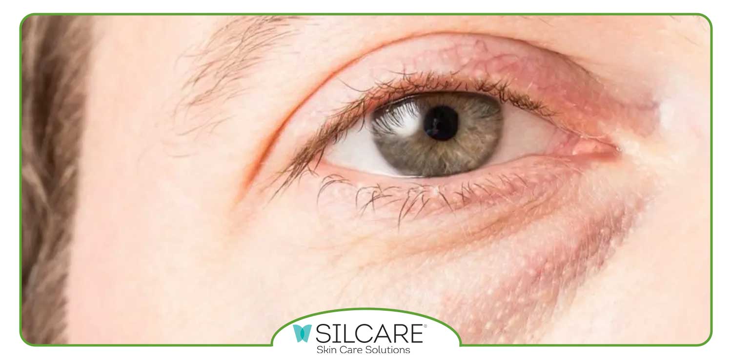 پف زیر چشم به چه دلایلی ایجاد می شود؟