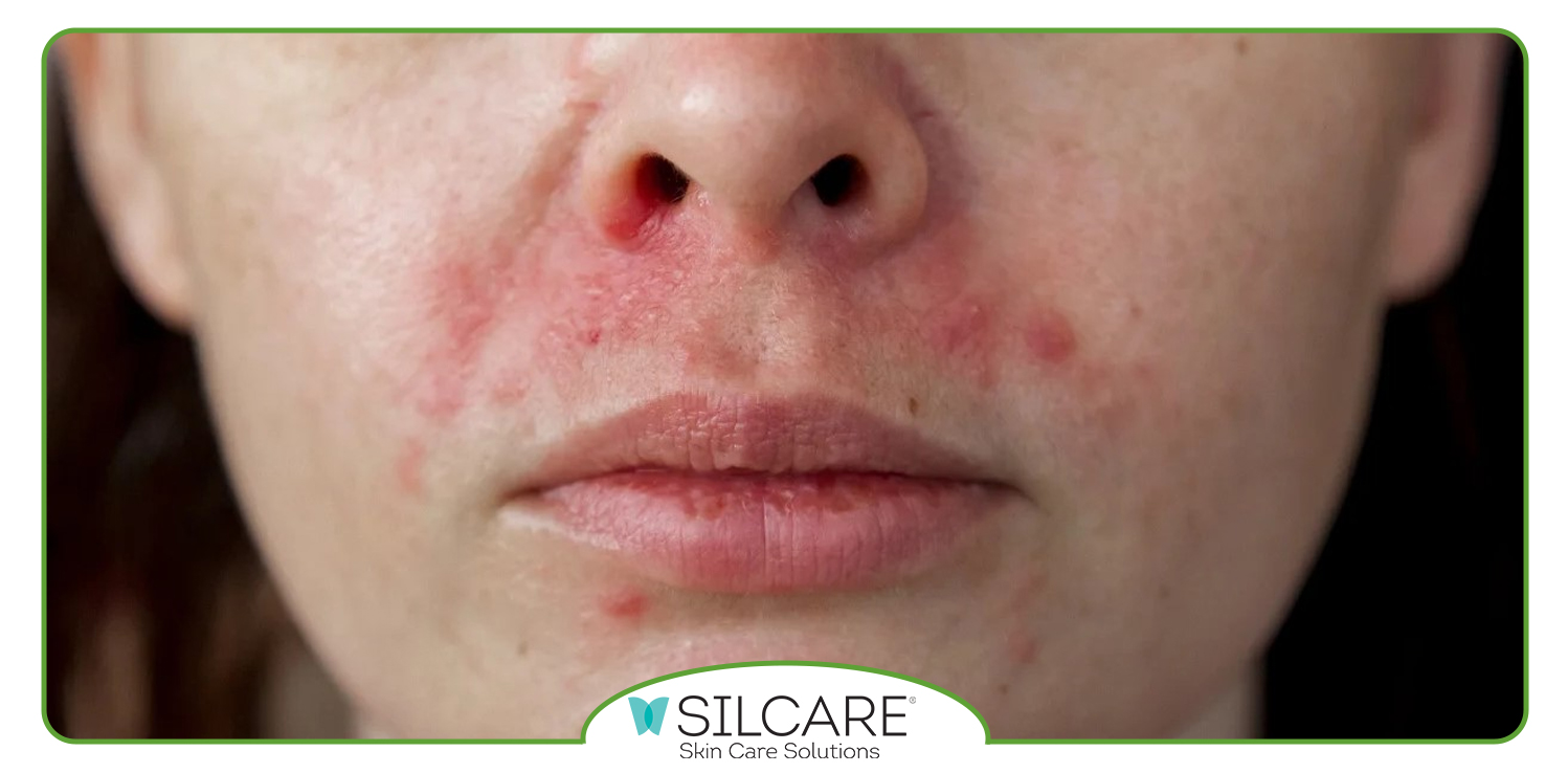 پماد برای حساسیت پوستی صورت