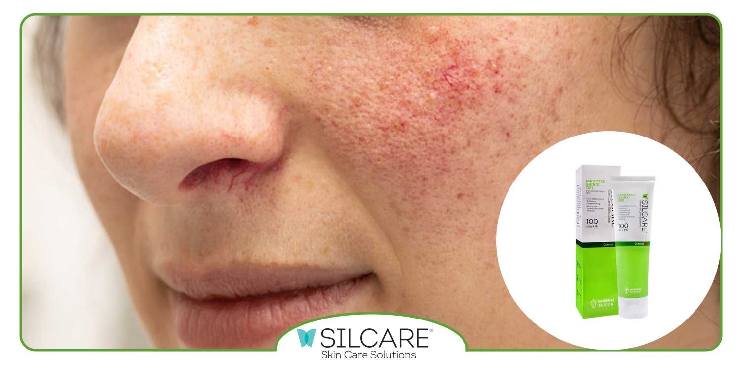 پماد برای قرمزی صورت