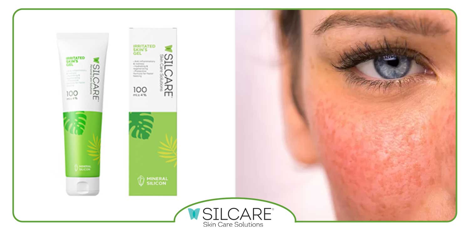 علت قرمز شدن پوست گونه ها