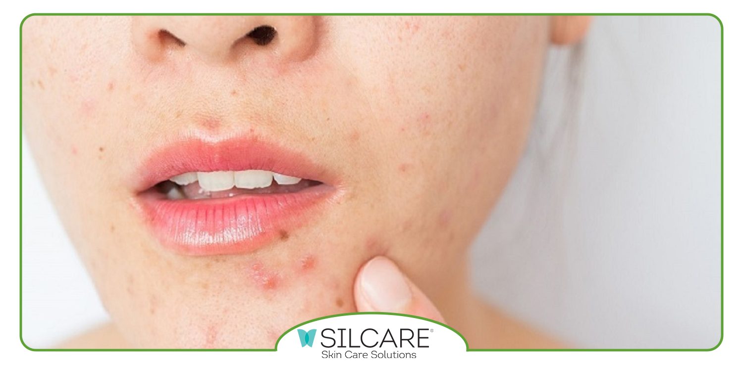 بهترین برند سرم ضدجوش برای پوست چرب