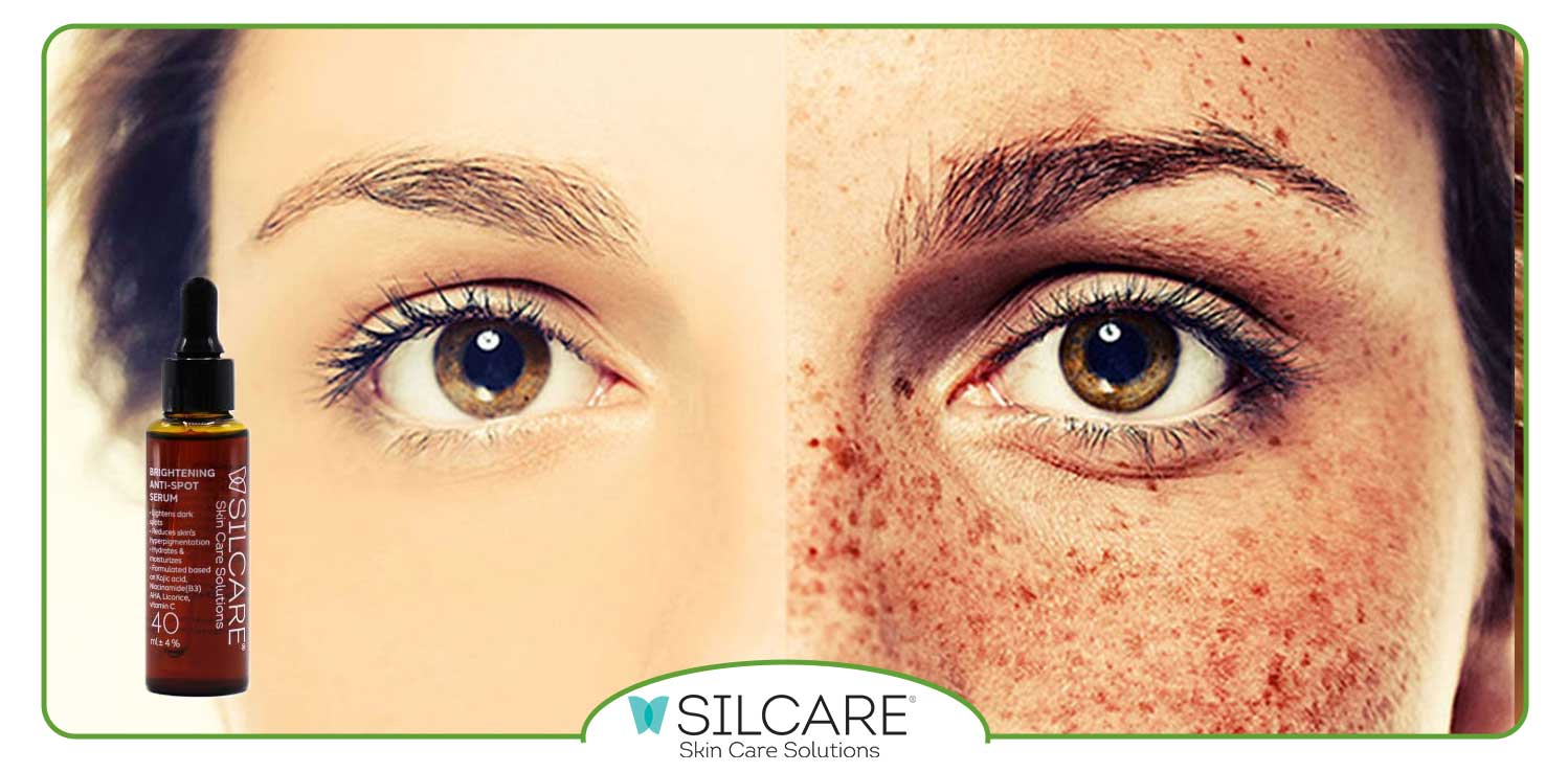 بهترین سرم برای از بین بردن کک و مک صورت