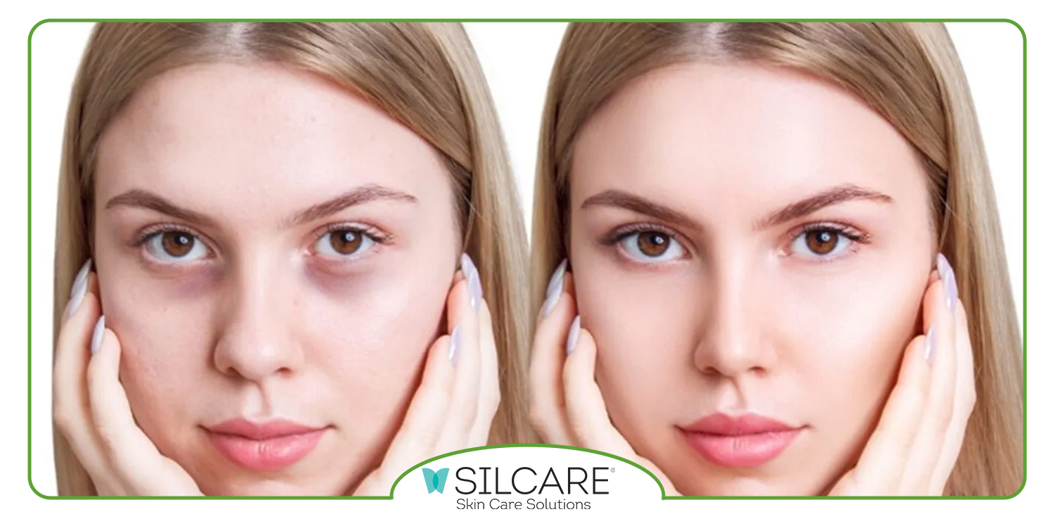 بهترین سرم برای رفع تیرگی دور چشم کدام است؟