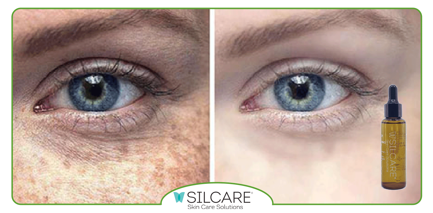 بهترین سرم ضد لک قوی