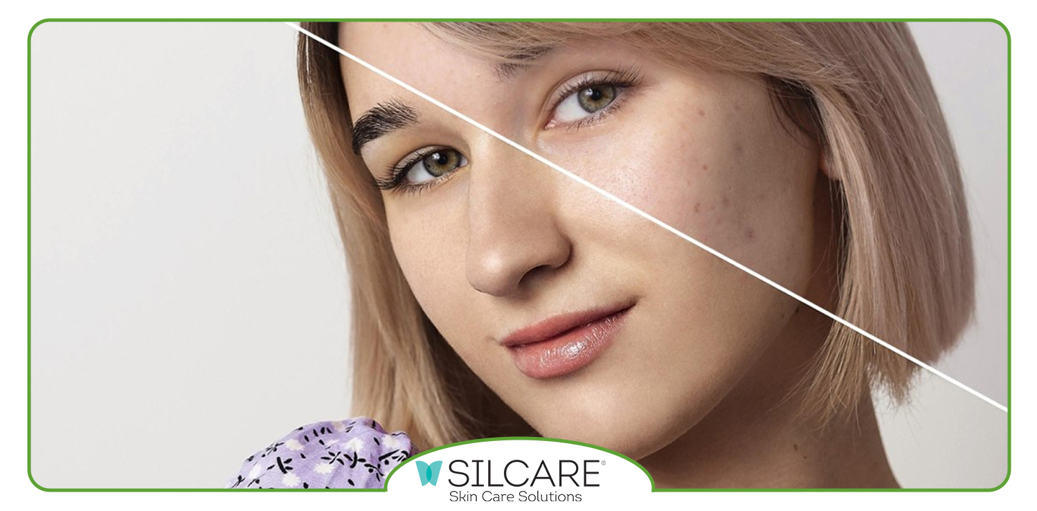 بهترین کرم ترمیم کننده بعد از لیزر