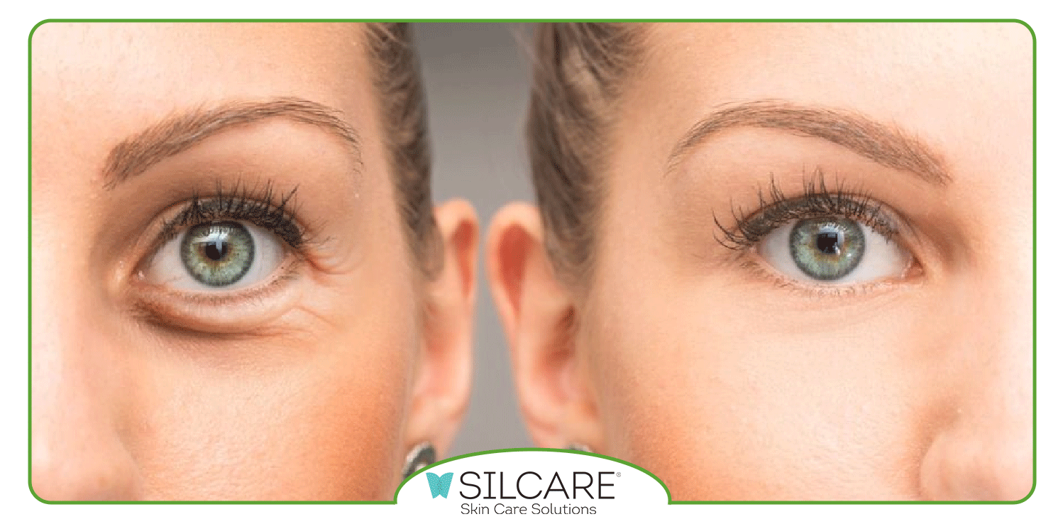 علت خشک شدن پوست دور چشم