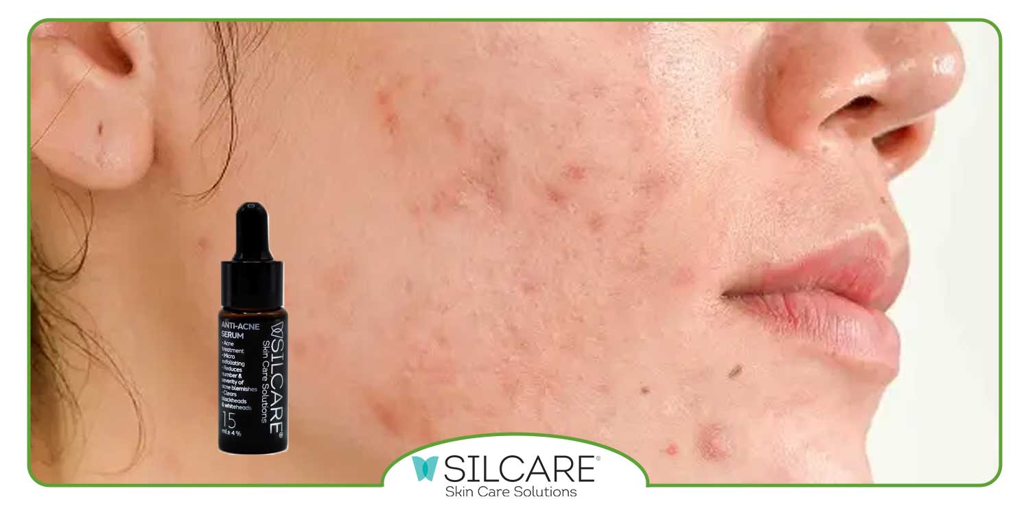 بهترین برند سرم ضد جوش و لک