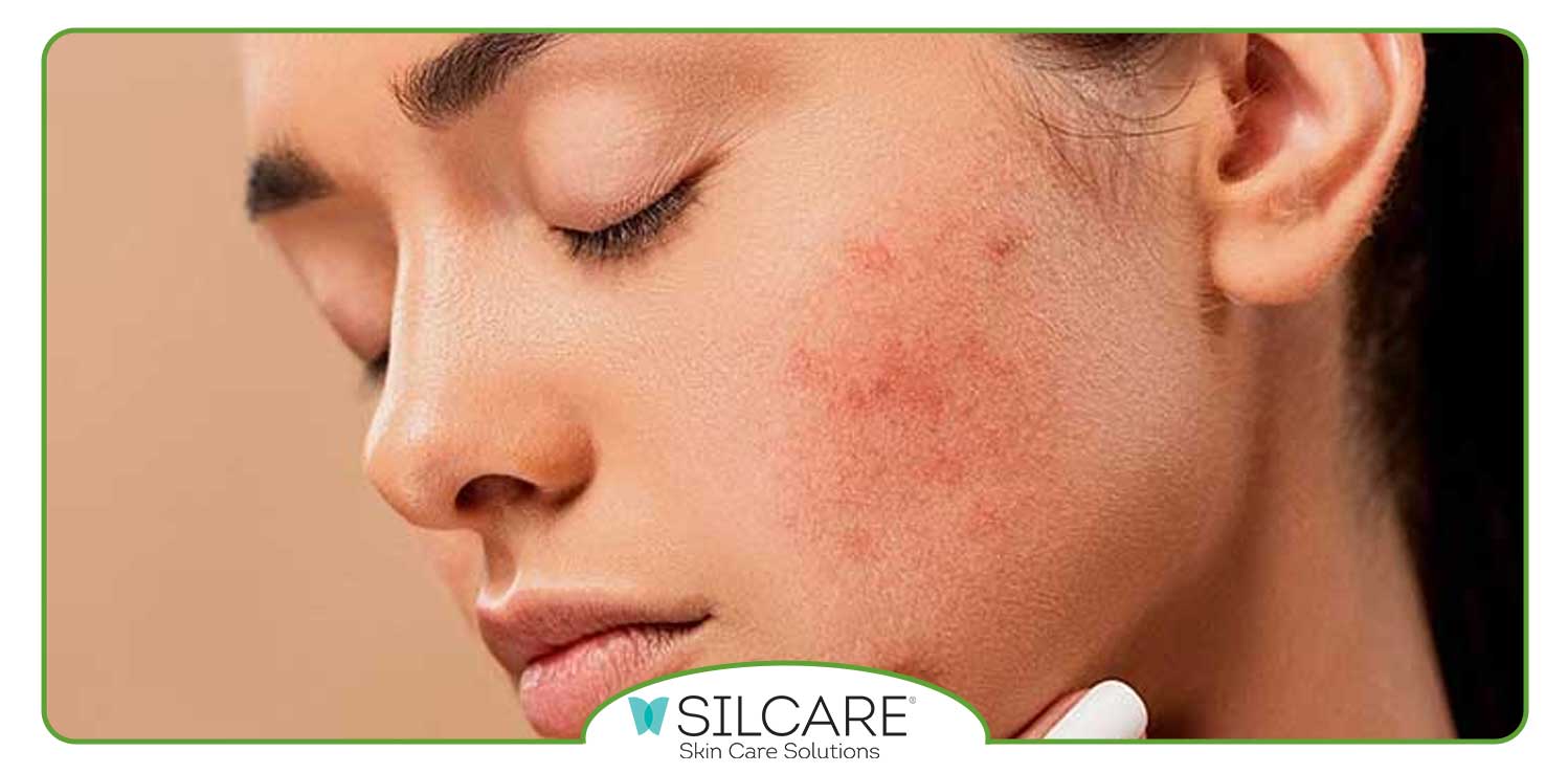 مهم ترین ترکیبات سرم ضد جوش