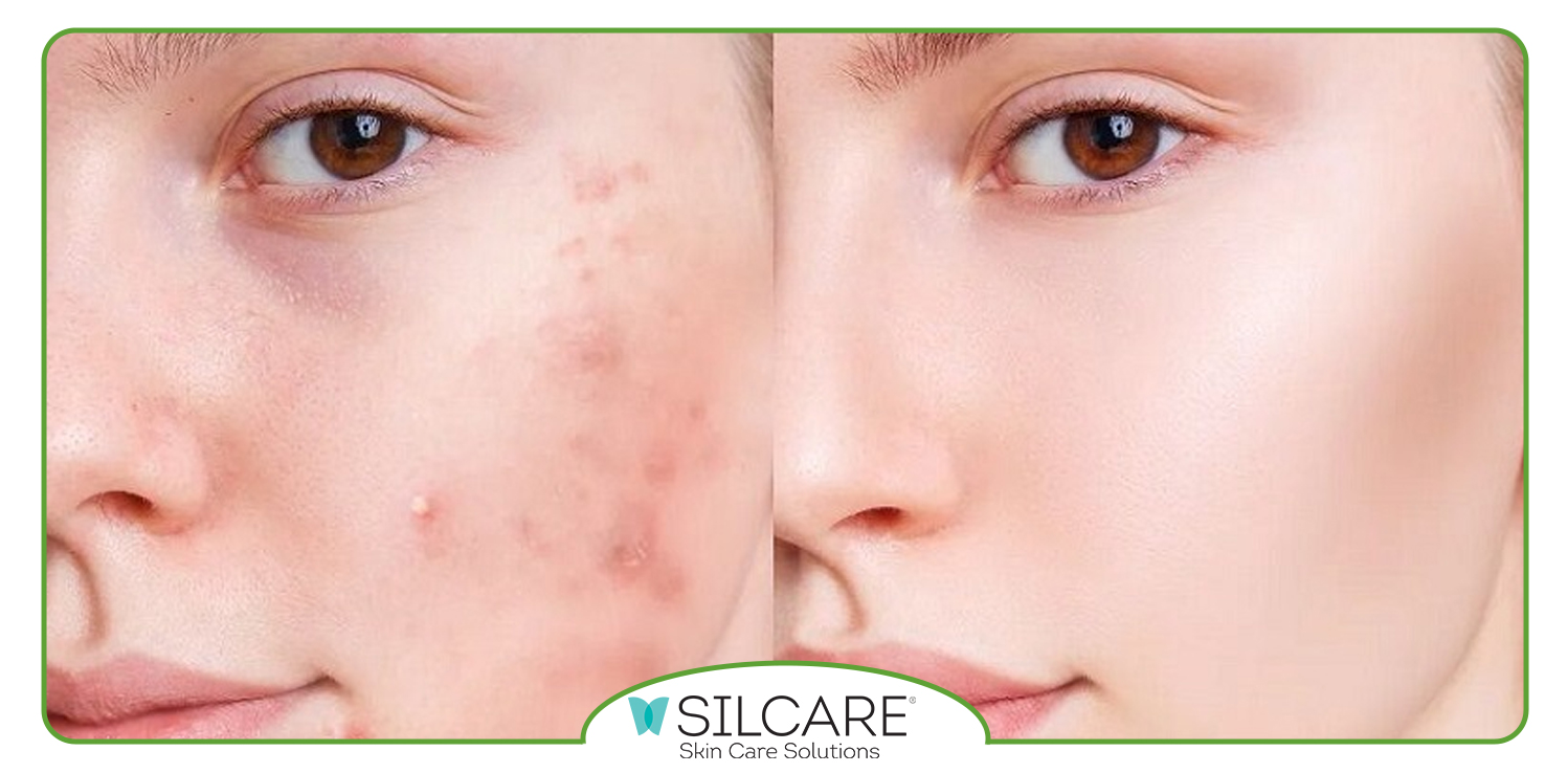 محلول ضد جوش قوی