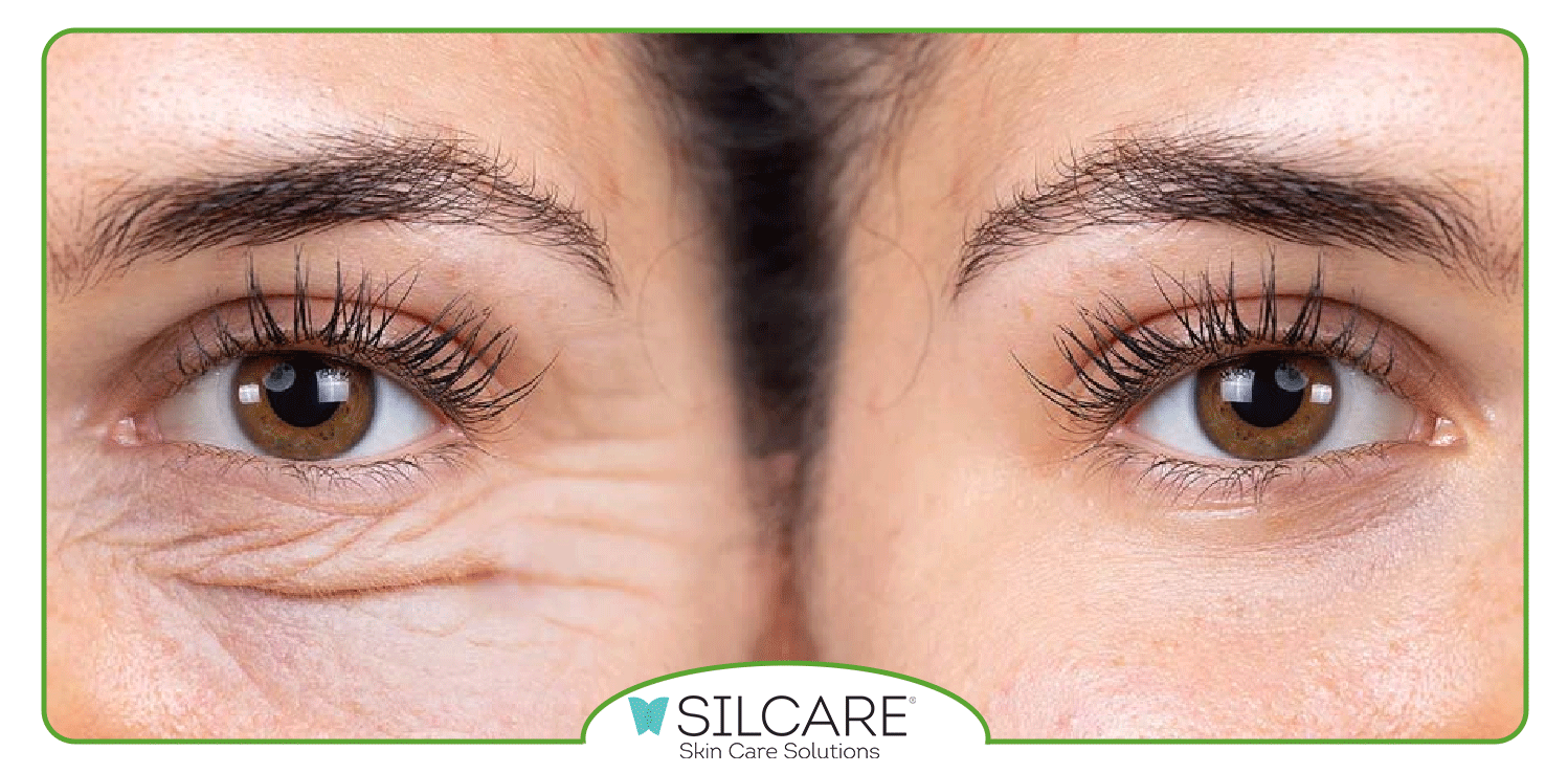 مزایای استفاده از سرم دورچشم سیلکر برای رفع تیرگی