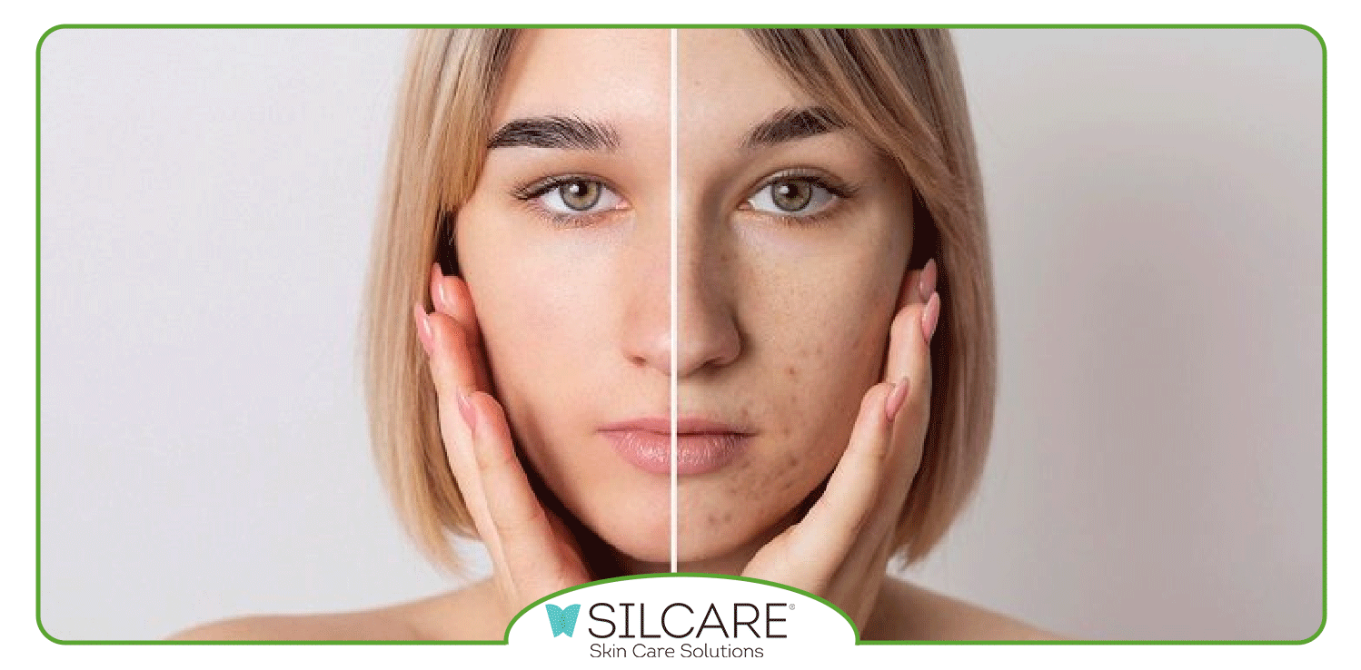 چگونه از سرم ضد لک سیلکر استفاده کنیم؟