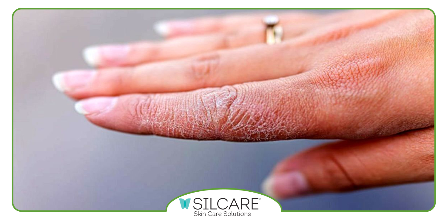 کرم مرطوب کننده قوی برای پوست خیلی خشک