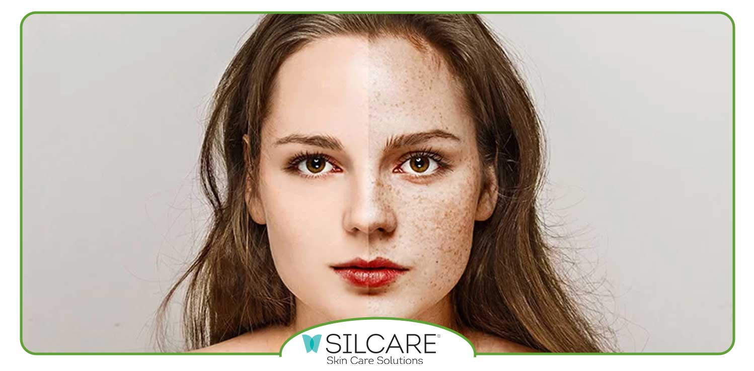 بهترین سرم برای از بین بردن کک و مک صورت