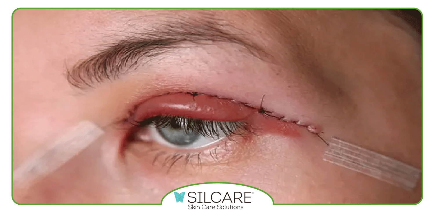 انواع کرم ترمیم کننده بعد از بلفاروپلاستی