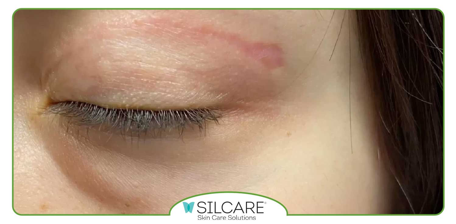 بهترین زمان استفاده از کرم ترمیم کننده بعد از بلفاروپلاستی