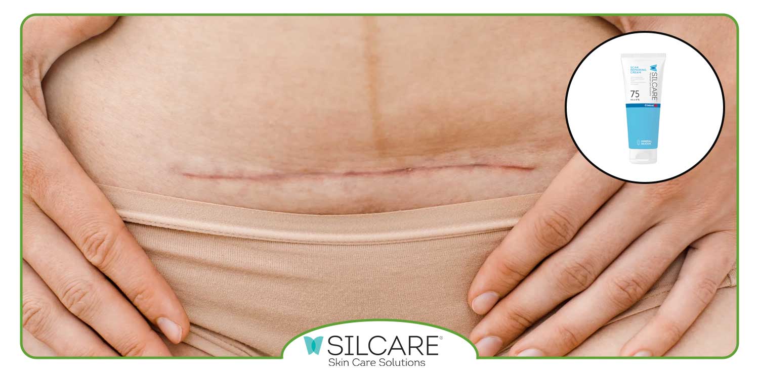 خرید کرم ترمیم کننده جای زخم سیلکر