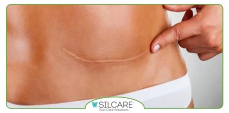 بهترین کرم ترمیم کننده جای بخیه سزارین