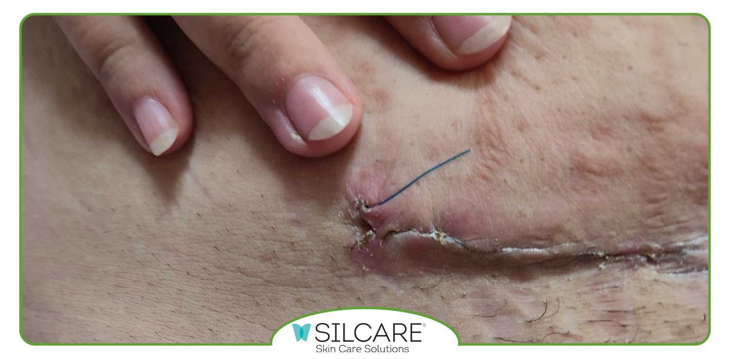 جای بخیه سزارین