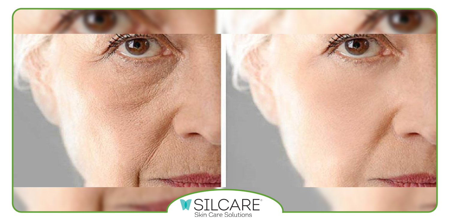 کرم لیفتینگ قوی صورت