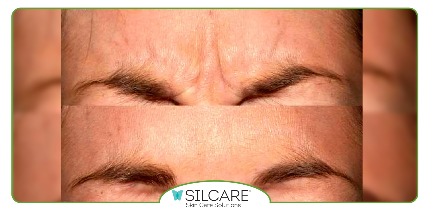 بهترین راه برای از بین بردن چین و چروک پیشانی