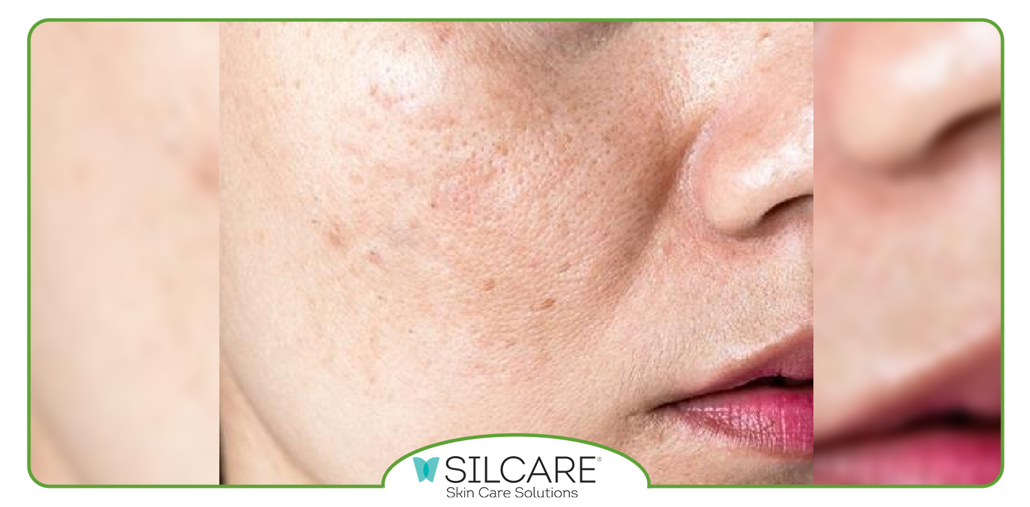 نحوه استفاده از سرم ضد لک سیلکر