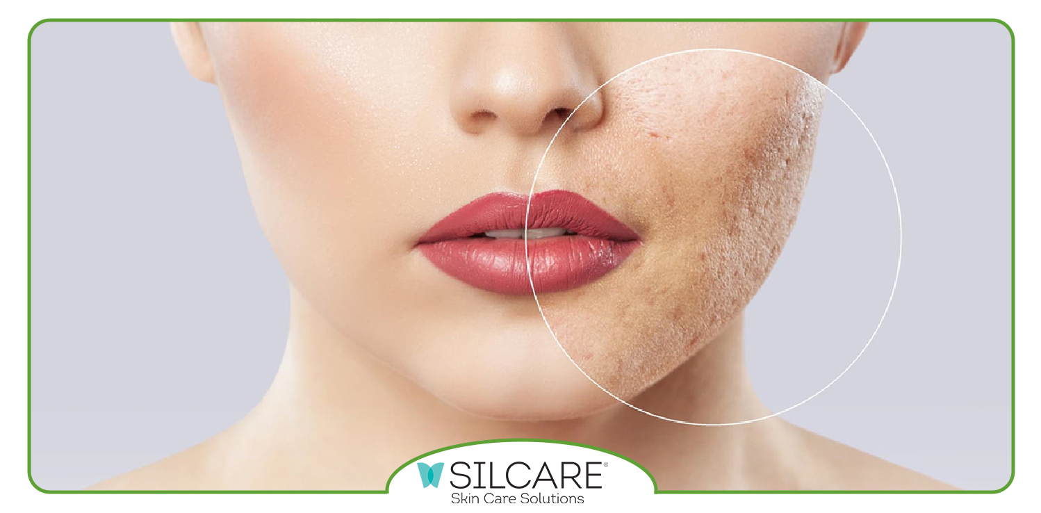 کرم silcare برای چیست؟