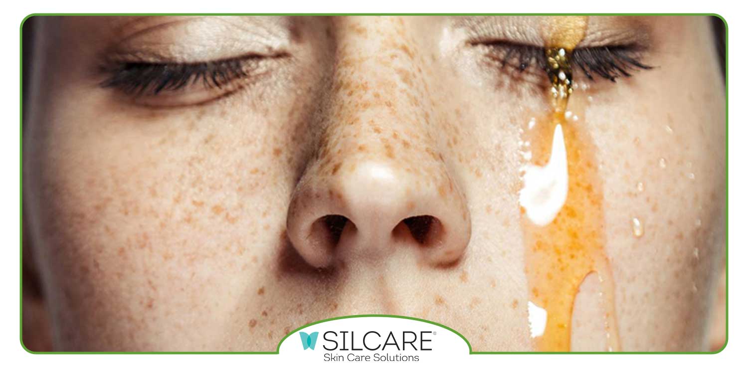 از بین بردن پف زیر چشم با عسل