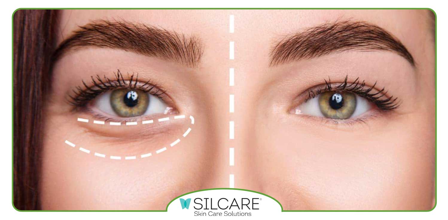 برای رفع پف زیر چشم چه کنیم؟