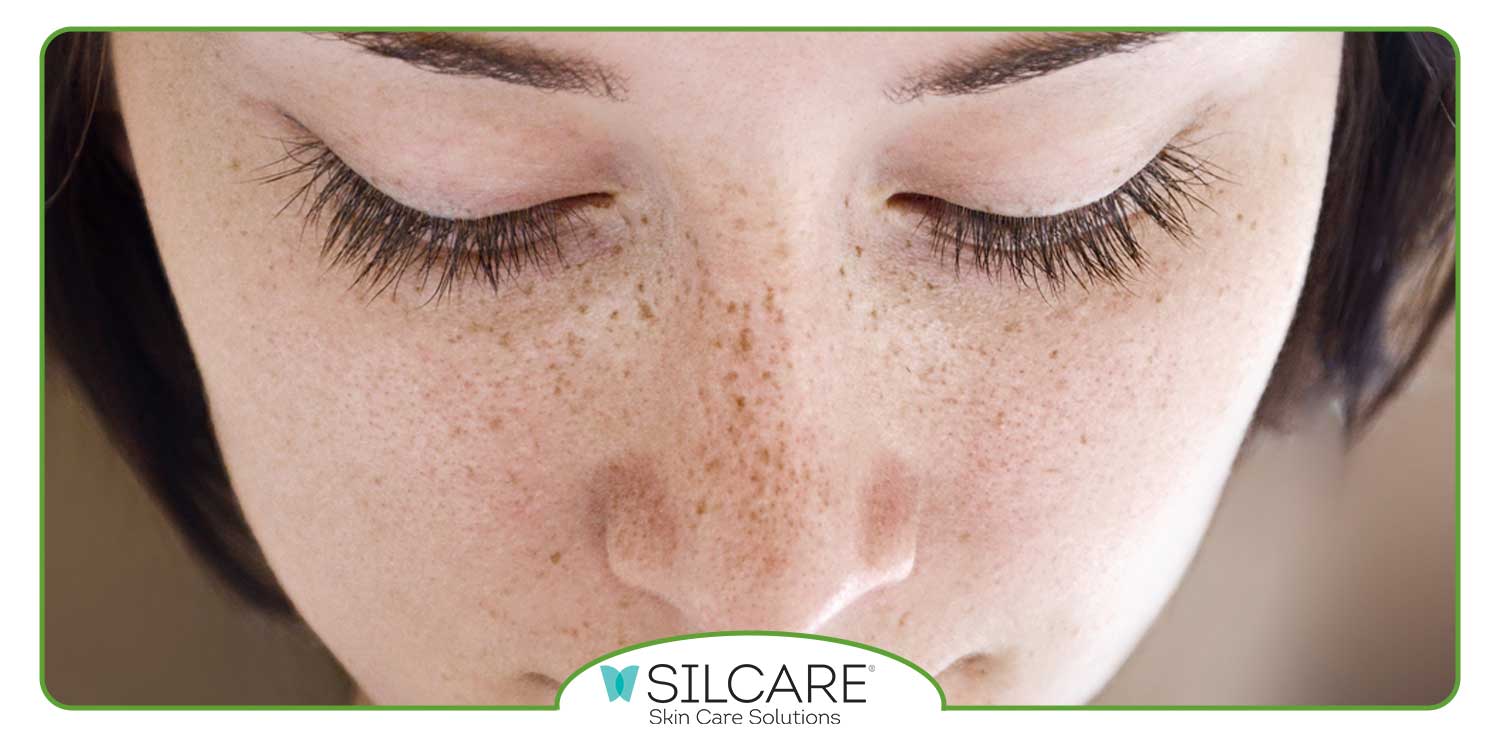 بهترین روش های از بین بردن کک و مک صورت