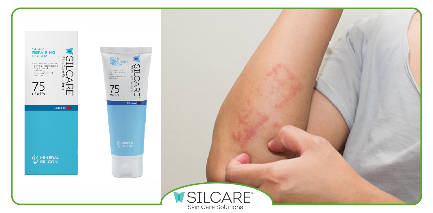 بهترین پماد و قرص برای اگزمای پوستی