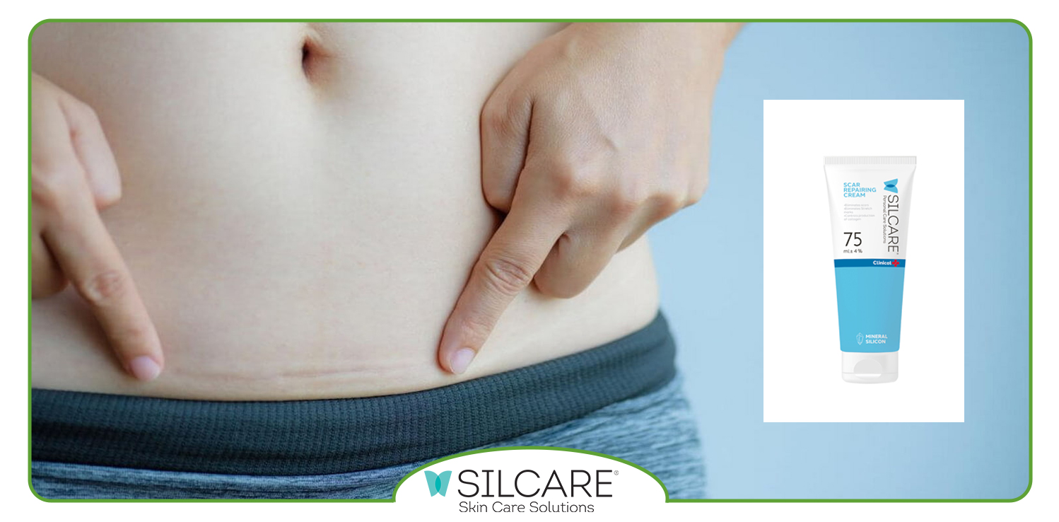 بهترین کرم ترمیم کننده جای بخیه سزارین ایرانی