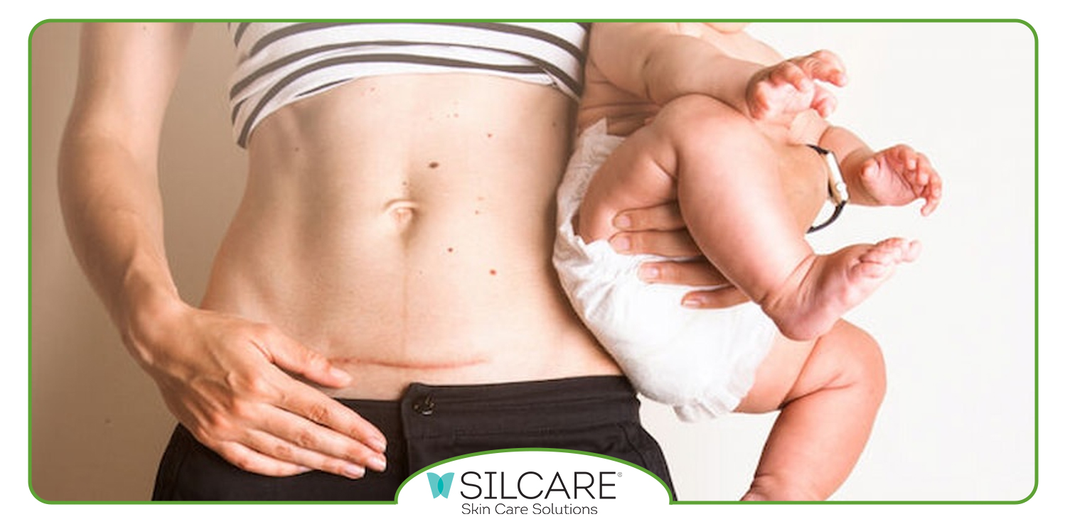 ترکیبات پماد ترمیم کننده جای بخیه سیلکر