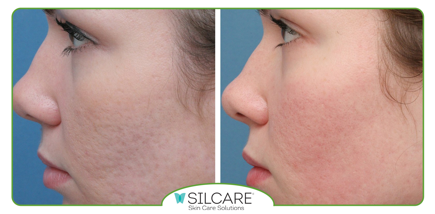 ترکیبات کرم ترمیم کننده جای جوش سیلکر