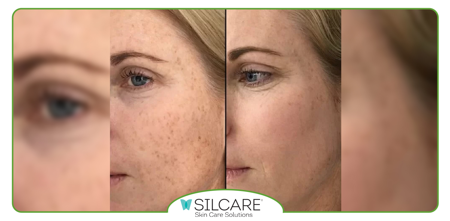 خرید سرم ضد لک و روشن کننده سیلکر