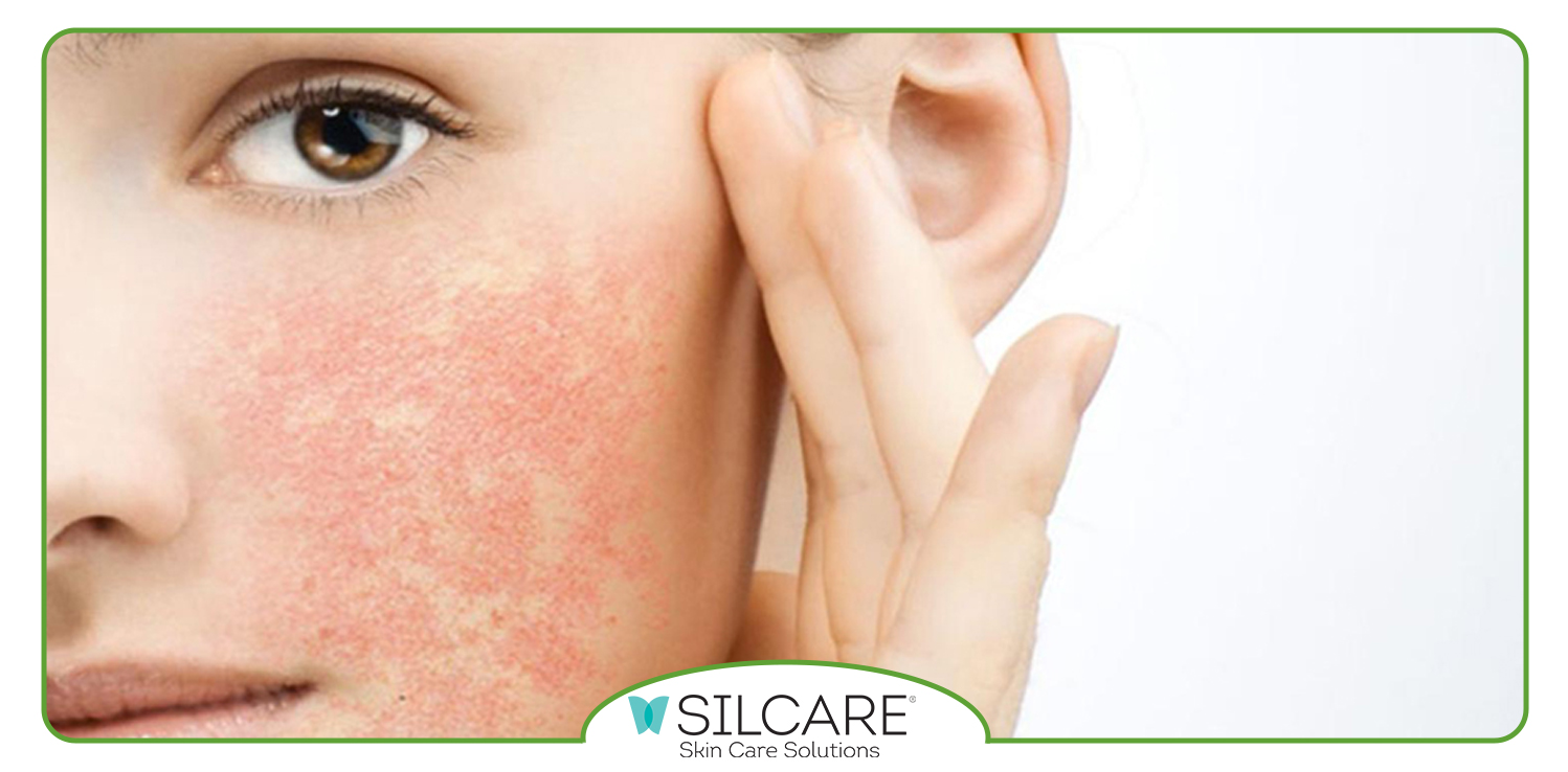 کرم مرطوب کننده پوست خیلی خشک 