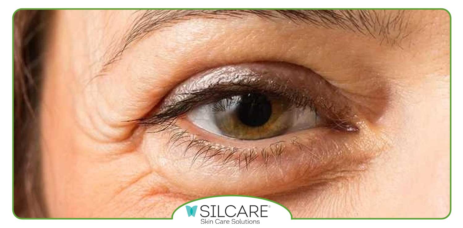 ارتباط-پف-زیر-چشم-و-کلیه-