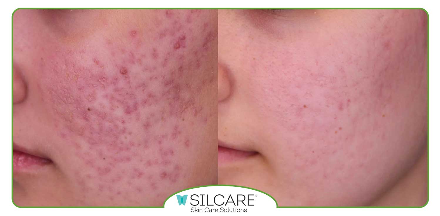 بهترین ترمیم کننده جای جوش