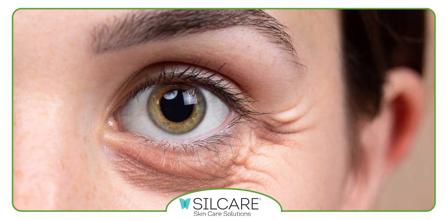 بهترین روش درمان پف زیر چشم در خانه