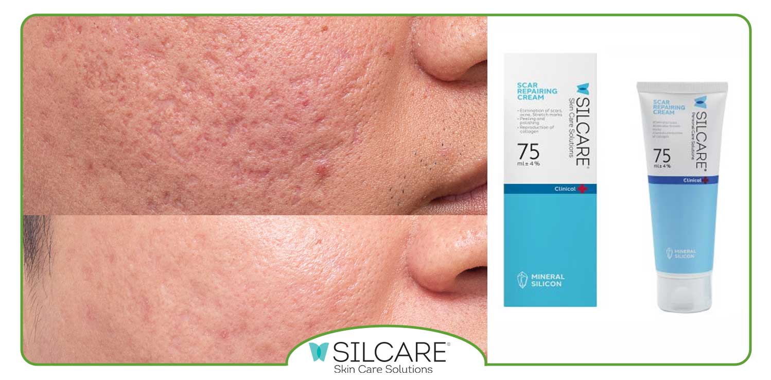 بهترین زمان استفاده از کرم ترمیم کننده جوش چه موقع است؟