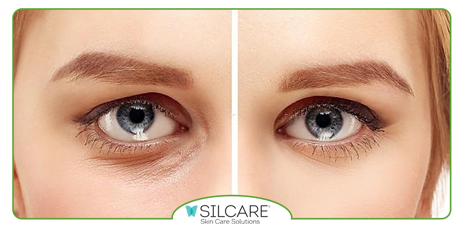 بهترین سرم دور چشم برای تیرگی و چروک